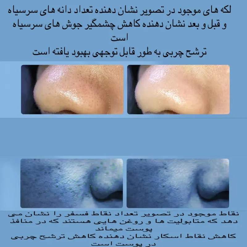 میکرودرم آبریژن خانگی مدل Super Micro Bubble